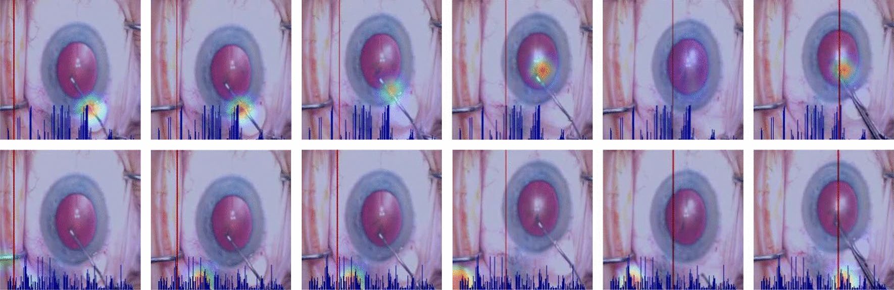 Spatial-temporal attention for video-based assessment of intraoperative surgical skill's image showing a brief idea of what this post is about.